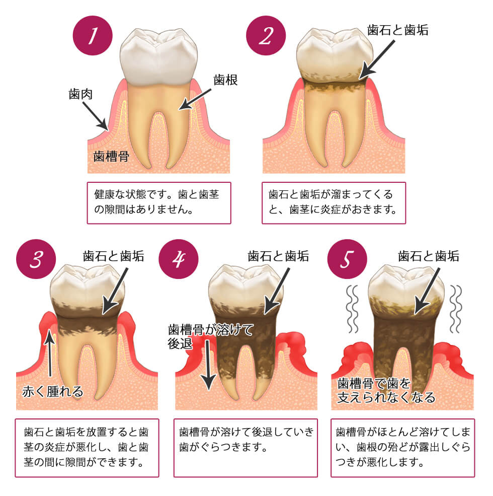 歯 周 病 喉 の 腫れ